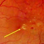 Angiopathy of the retina of both eyes (eyes)