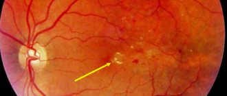 Angiopathy of the retina of both eyes (eyes)