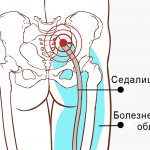 Pain due to inflammation of the sciatic nerve