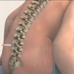 Back pain after epidural anesthesia causes treatment