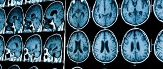 What is shown on MRI results of the brain?