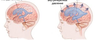 What is intracranial pressure