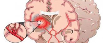 Hemorrhagic stroke - what is it?