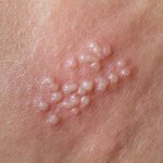 herpetic rash