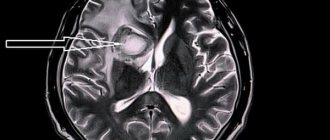 Stroke on MRI of the brain