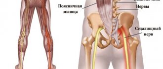 Sciatica is an inflammation of the sciatic nerve