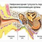 Как и чем лечить кохлеарный неврит слухового нерва. нейросенсорная тугоухость (кохлеарный неврит): причины, симптомы и лечение кохлеарный неврит слухового нерва симптомы лечение
