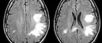 Pictures upon request MRI leukoencephalopathy