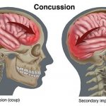 Контузия головного мозга - особо опасный вид контузии