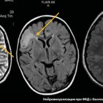 Кортикальная дисплазия на МРТ головного мозга