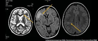 Cortical dysplasia on brain MRI