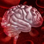 Brain hemorrhage: causes and treatment