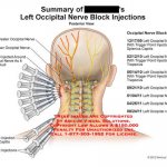 Treatment of occipital neuralgia