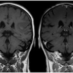 MRI of the brain with contrast, why contrast is needed