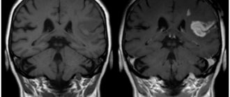 MRI of the brain with contrast, why contrast is needed