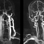 MRI of neck vessels