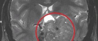 What does MRI of the sella turcica show?