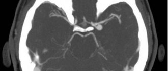 On a computed tomogram: aneurysm of the left internal carotid artery