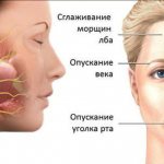 Facial neuritis