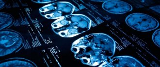 Почему происходит эпилептический припадок: причины и предвестники эпилепсии