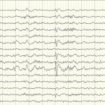 Regional epileptiform activity “acute-slow wave” in the right temporo-parietal region in patient V., 72 years old, against the background of pronounced interhemispheric asymmetry and relative preservation of the background EEG in the intact left hemisphere of the brain. Recording against the background of sleep deprivation. 
