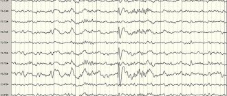Региональная эпилептиформная активность «острая-медленная волна» в правой височно-теменной области у пациентки В., 72 лет на фоне выраженной межполушарной асимметрии и относительной сохранности фоновой ЭЭГ в интактном левом полушарии головного мозга. Запись на фоне депривации сна.