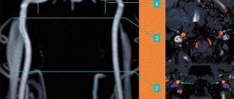 С помощью двумерной фазово-контрастной МР-ангиографии (2D PCA) можно оценить количественные характеристики магистрального кровотока на нескольких уровнях в просвете мозговых артерий. Вверху – визуализация неравномерности распределения скоростных характеристик в просвете разных сегментов внутренних сонных артерий – парных крупных артерий шеи и головы, по данным 2D PCA. Срезы устанавливались перпендикулярно ходу артерий на шейном уровне, с одновременным захватом правого и левого сосуда. В специальной программе полученные томограммы обрабатывались с созданием геометрической фигуры, отграничивающей так называемую область интереса (в данном случае – просвет артерии), внутри которой определялись значения объемной, пиковой и средней скоростей кровотока, а также площадь поперечного сечения сосуда в каждую из фаз цикла сердечной деятельности. Цифрами отмечены уровни визуализации кровотока во внутренних сонных артериях, стрелками – просветы артерий на разных уровнях