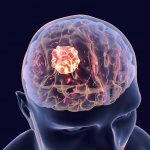 Симптоматическая эпилепсия с генерализованными приступами: причины и признаки