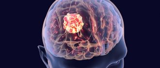 Симптоматическая эпилепсия с генерализованными приступами: причины и признаки