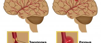 Experts distinguish two types of stroke - ischemic and hemorrhagic.