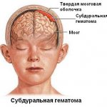 Subdural hematoma of the brain