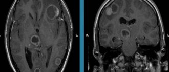 Toxoplasmosis on MRI of the brain