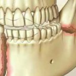 Травма челюсти - Стоматология Линия Улыбки