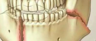 Травма челюсти - Стоматология Линия Улыбки