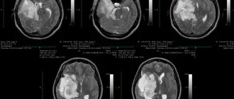 Removal of a large GRADE II WHO astrocytoma of the right temporal lobe (before surgery)