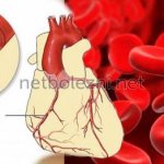 Blockage of arteries with plaque